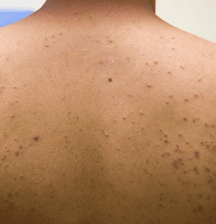 Close up of Folliculitis