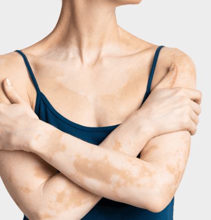 Dermatologist examining patient’s skin for vitiligo patches