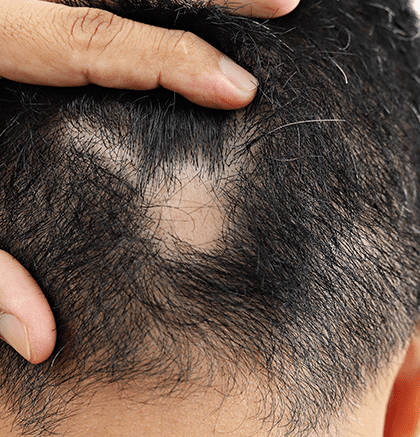 Alopecia Areata Treatment in Austin | Hair Loss Dermatologist