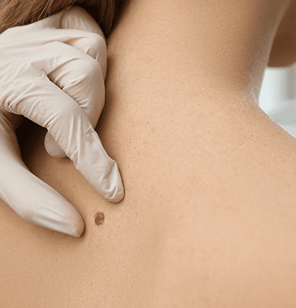 Dermatologist examining patient’s skin for birthmarks