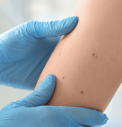 Dermatologist examining patient’s skin cyst during consultation