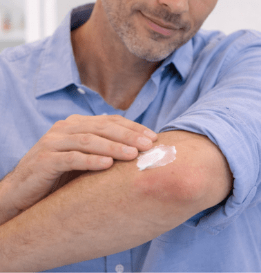 Man applying prescribed topical cream to a mild psoriasis patch on his elbow