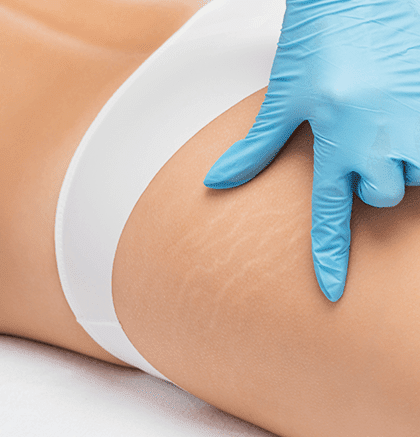 Dermatologist examining patient’s skin for stretch marks