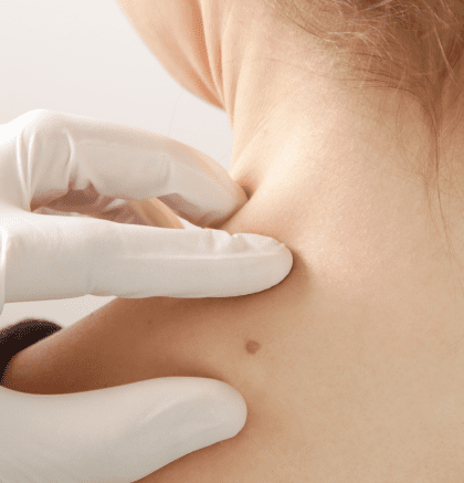 Dermatologist examining small red cherry angioma on patient’s skin